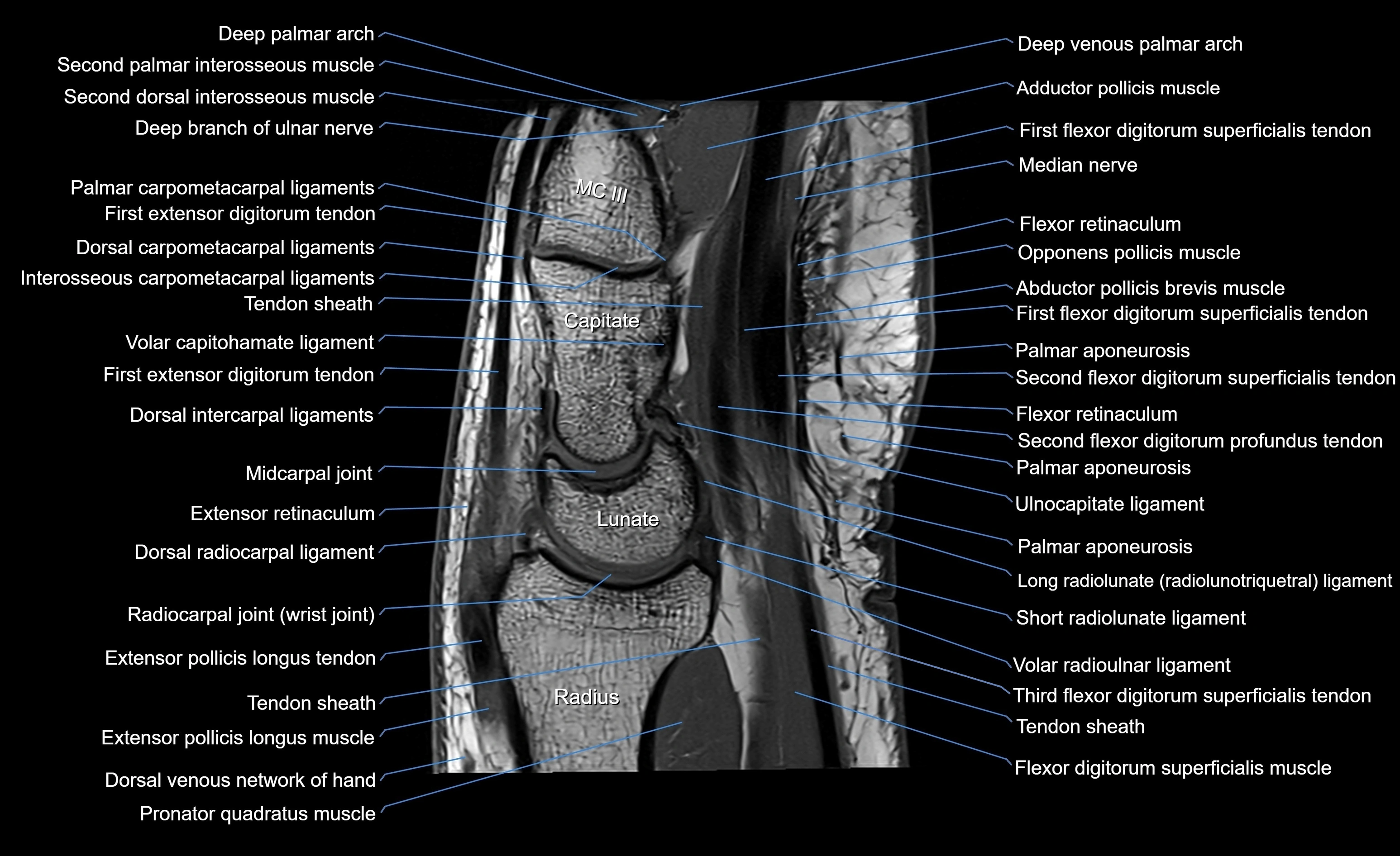 MRI wrist sagittal cross sectional anatomy 3T  radiology  image-img-00001-00013.webp